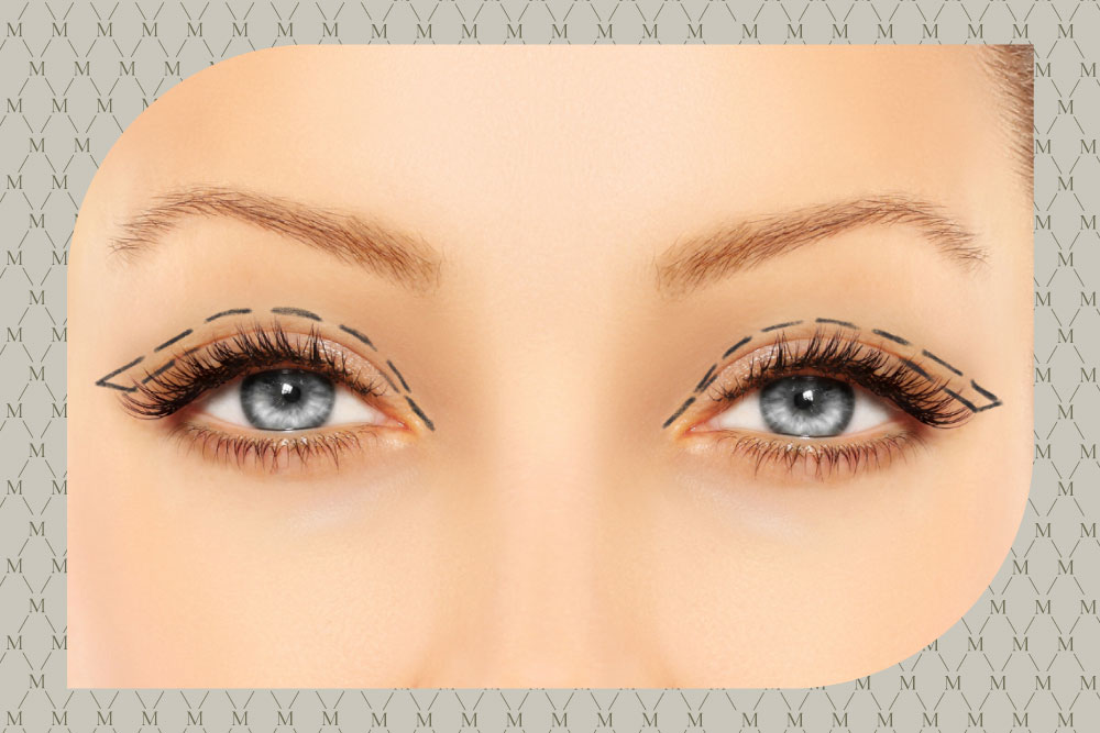 Martha-Lang - Blefaroplastia-Superior-80