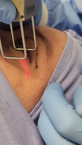 laser de co2 ponteira full face blefroplastia