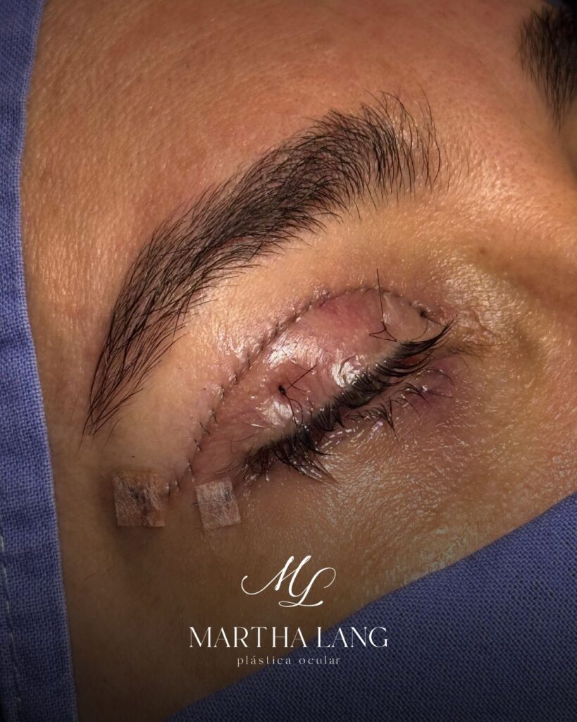 Blefaroplastia e correção de ptose na mesma cirurgia