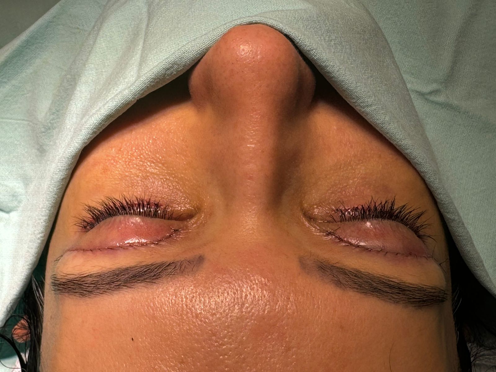 Blefaroplastia e Correção de Ptose: Entenda as Diferenças e Quando ...